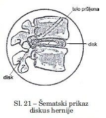 https://ordinacijazivot.com/wp-content/uploads/2022/12/Sematski-Prikazan-diskus-hernije-214x240.jpg